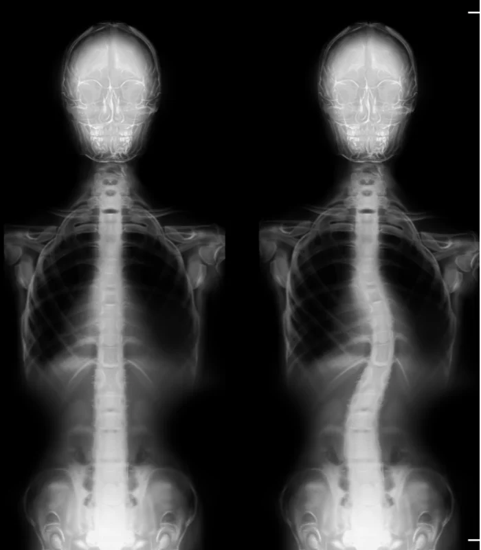 Scoliosis Treatment In Ann Arbor